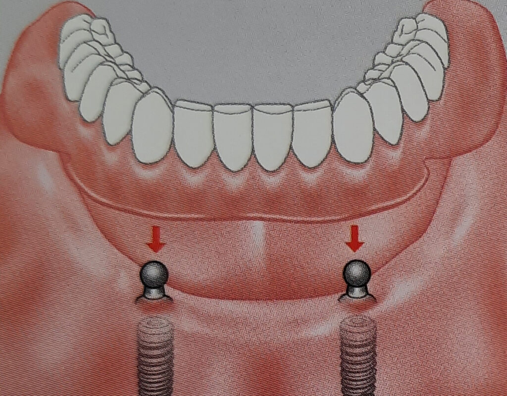 Tilskud til din tandprotese - dansk tandteknik